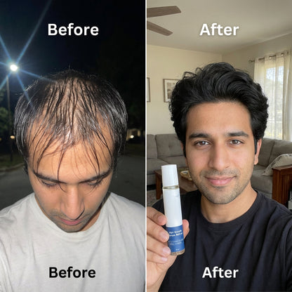 🎉BUY 1 GET 1 FREE🎉Hair Growth Roll on Serum