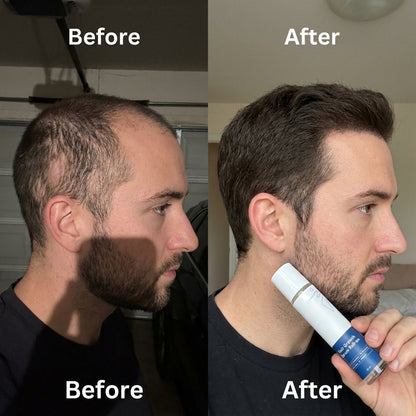 🎉BUY 1 GET 1 FREE🎉Hair Growth Roll on Serum