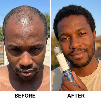 🎉BUY 1 GET 1 FREE🎉Hair Growth Roll on Serum